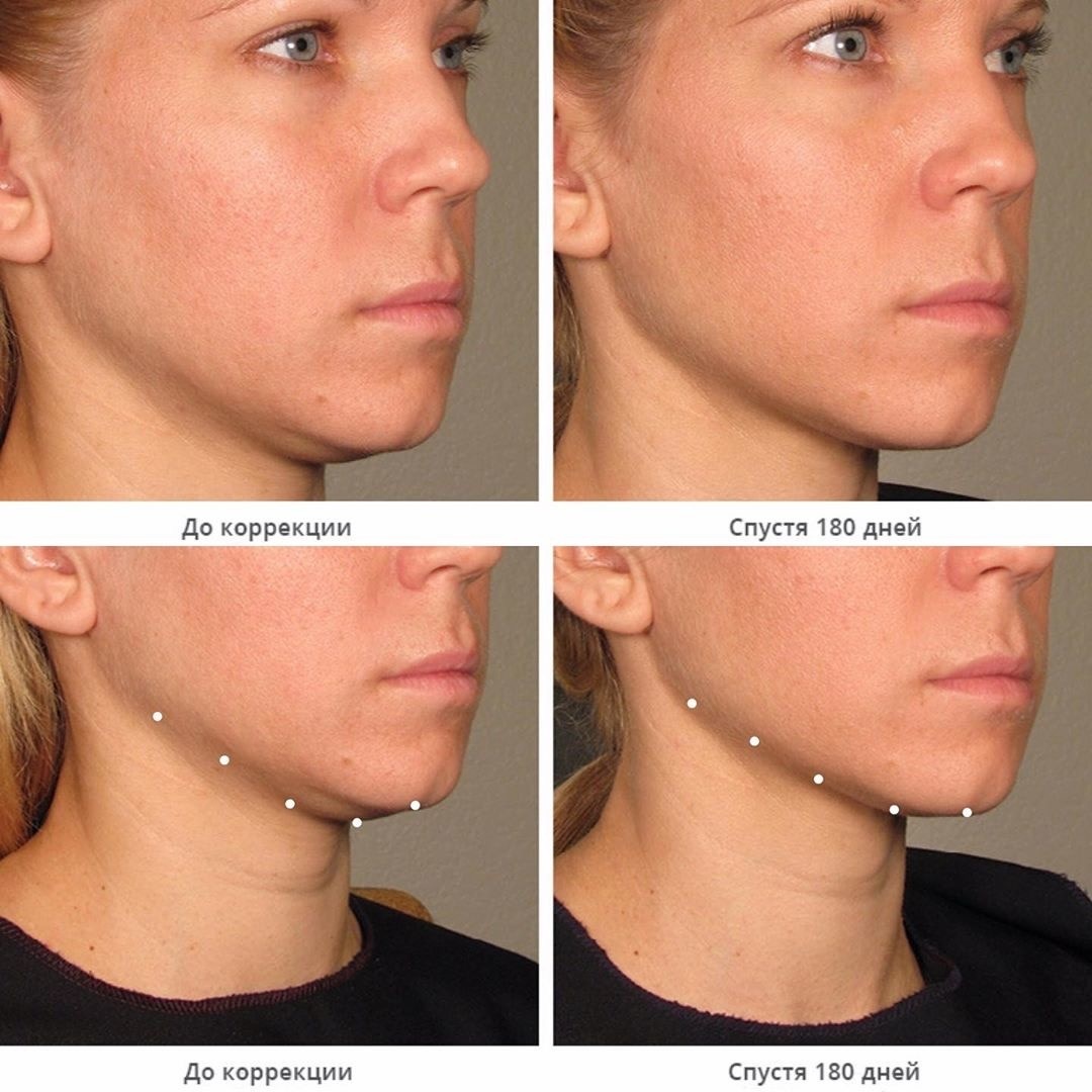 Безоперационная подтяжка лица - фото до и после