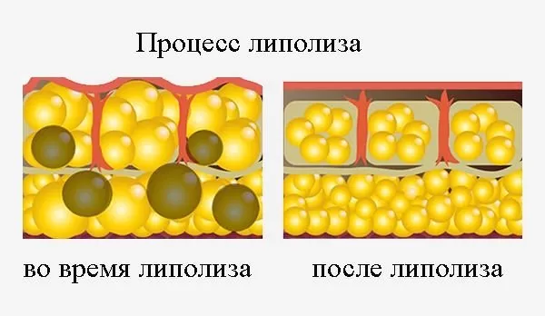 Как работает липолиз?
