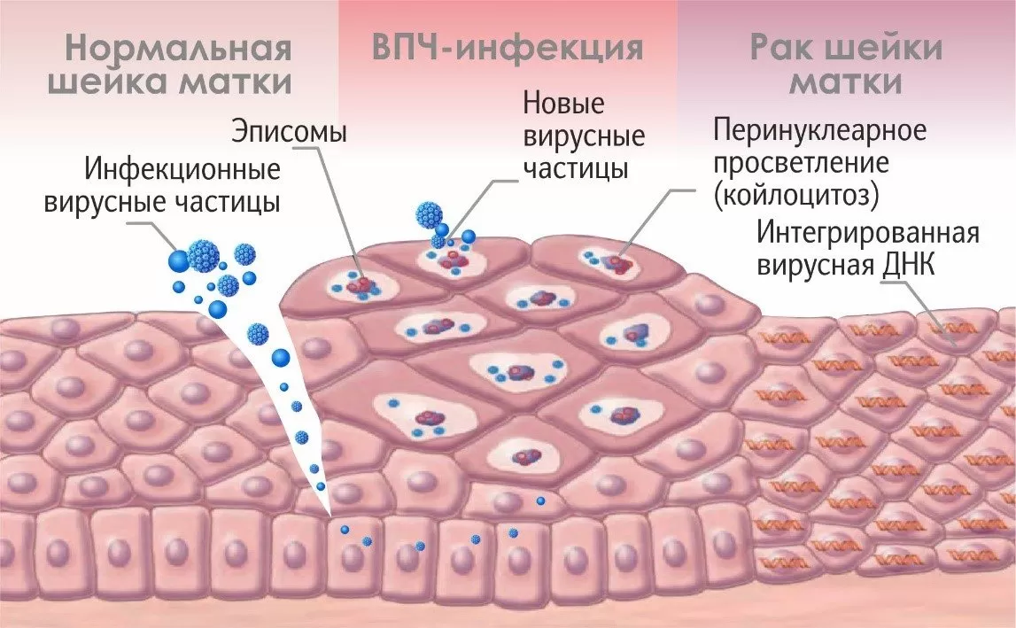 Мазок на ВПЧ высокого онкологического риска — после