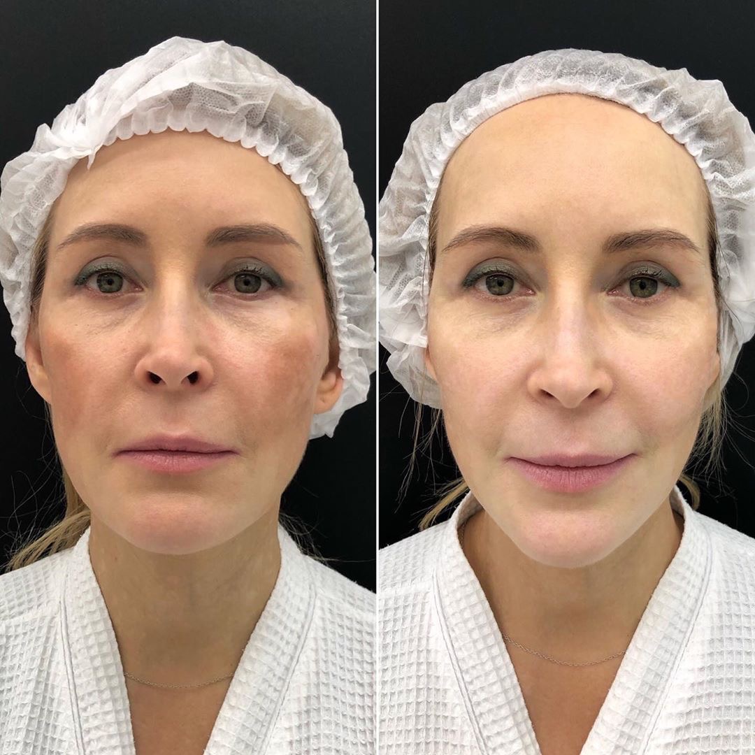 Фото до и после - Консультация врача-косметолога