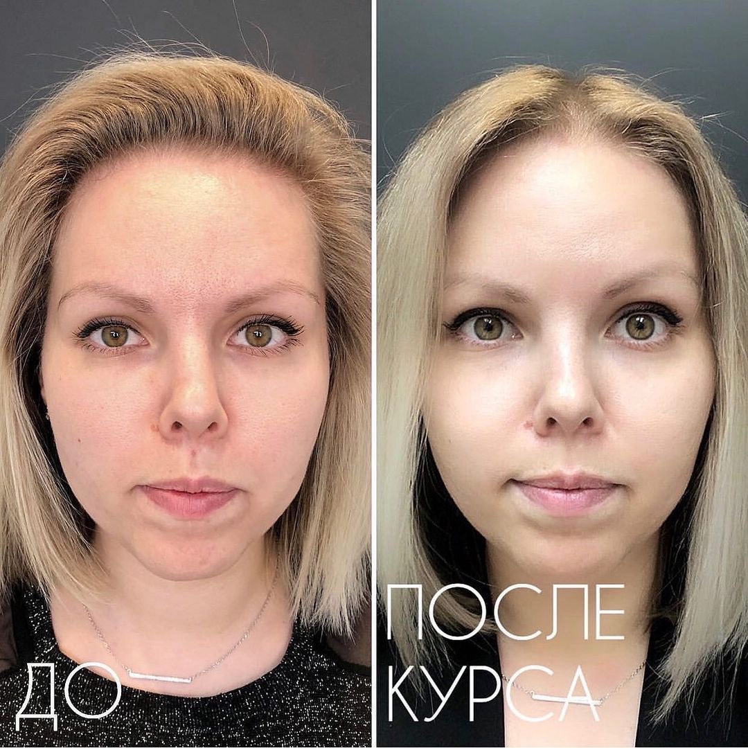 Фото до и после процедуры Биоревитализация