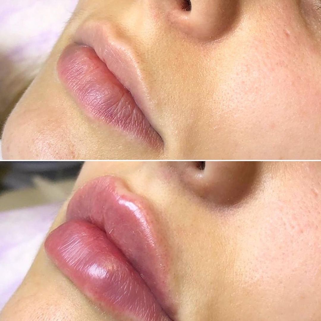 Фото до и после - Коррекция формы губ